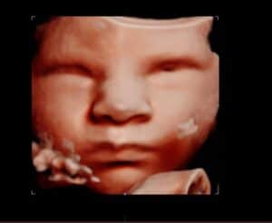 Photo Gallery Pittsburgh 4D Elective 3D ultrasound facial view photo Pittsburgh