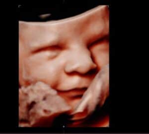 Photo Gallery Pittsburgh 4D Elective 3D ultrasound baby face photo in Pittsburgh PA