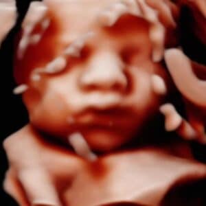 Photo Gallery Pittsburgh 4D Elective Pittsburgh 3D ultrasound baby face image