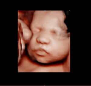 Photo Gallery Pittsburgh 4D Elective 4D ultrasound photo in Pittsburgh PA